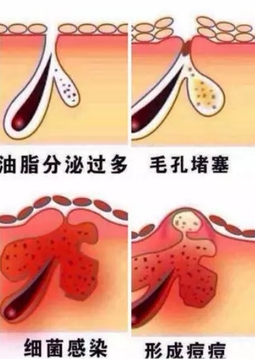 毛孔粗大、痘痘频发、闭口多多,用stridex施颜适水杨酸棉片就可以了!