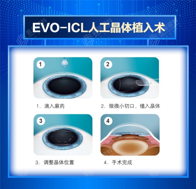 寒假摘镜总动员｜ICL晶体植入术为什么受欢迎？