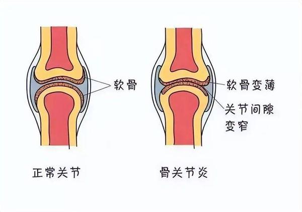 中老年人膝关节怎么保养？除了补钙还要注意这些！