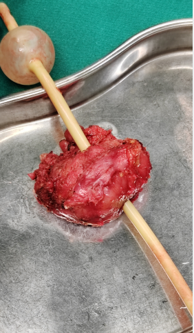 重庆结石病医院|强强联合 明好外科团队，重医教授专家同台献技，一次手术解决两个困扰