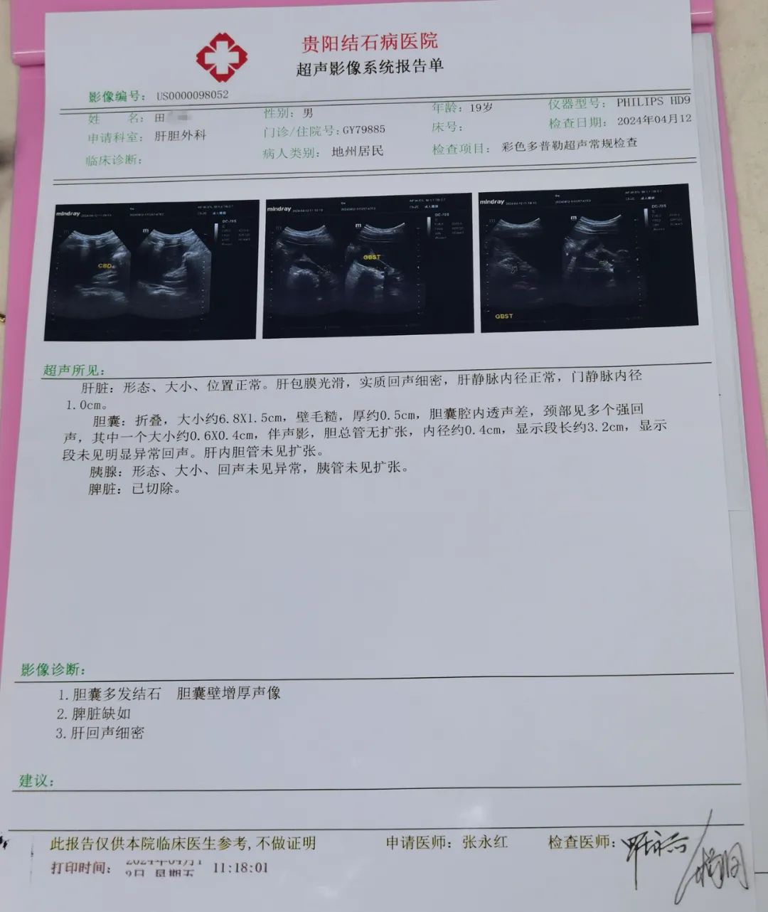 贵阳结石病医院为19岁高位截瘫小伙成功保胆取石