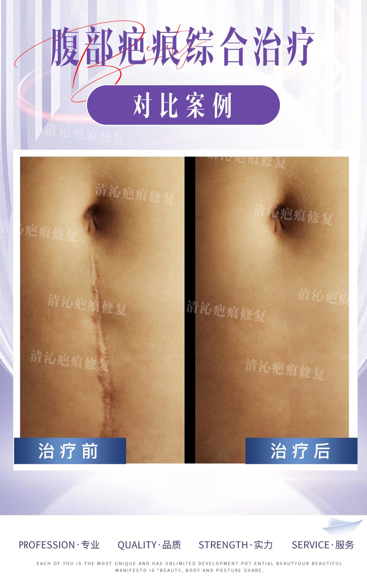 上海清沁疤痕修复中心助力宝妈：剖腹产疤痕不再是美丽绊脚石