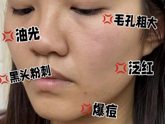油痘肌正确洁面方式，选对洗面奶是王道！