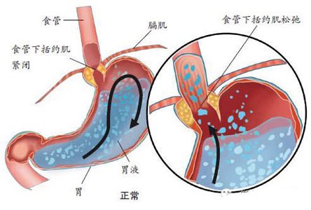 解密胃食管反流：从症状到预防全知晓