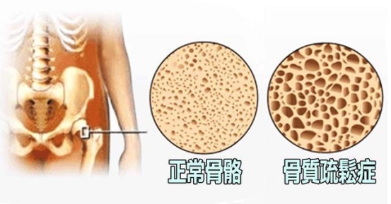 中老年补钙当心血管钙化，Jarrow Bone up——送长辈的放心钙