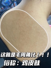 施颜适水杨酸棉片：春夏季鸡皮肤的救星