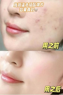 痘痘不是罪，写给每个想和痘痘体面告别的人