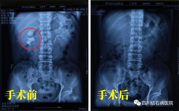 患者肾结石多年反复折磨，最终在四川结石病医院解除困扰！「四川肾结石专科医院」