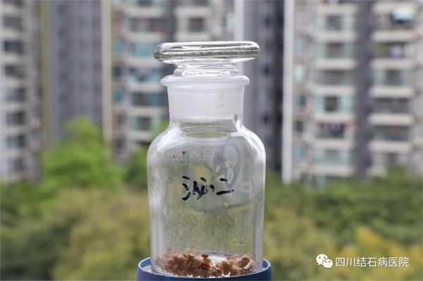 患者肾结石多年反复折磨，最终在四川结石病医院解除困扰！「四川肾结石专科医院」